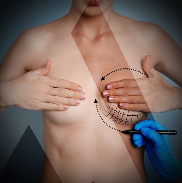 breast-augmentation-turkey